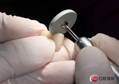 上前牙骨量不足種植+信封式植骨(梁光強(qiáng)) 上前牙骨量不足種植+信封式植骨(梁光強(qiáng))