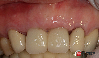 上前牙骨量不足種植+信封式植骨(梁光強(qiáng)) 上前牙骨量不足種植+信封式植骨(梁光強(qiáng))