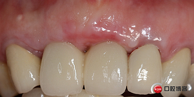 上前牙骨量不足種植+信封式植骨(梁光強(qiáng)) 上前牙骨量不足種植+信封式植骨(梁光強(qiáng))