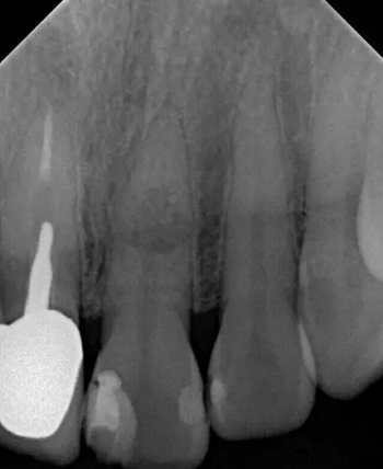 伴隨根管內(nèi)鈣化物形成牙根內(nèi)吸收治療1例 伴隨根管內(nèi)鈣化物形成牙根內(nèi)吸收治療1例