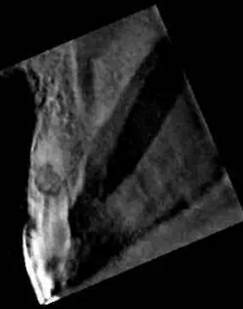 伴隨根管內(nèi)鈣化物形成牙根內(nèi)吸收治療1例 伴隨根管內(nèi)鈣化物形成牙根內(nèi)吸收治療1例