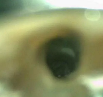 伴隨根管內(nèi)鈣化物形成牙根內(nèi)吸收治療1例 伴隨根管內(nèi)鈣化物形成牙根內(nèi)吸收治療1例