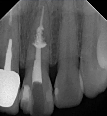 伴隨根管內(nèi)鈣化物形成牙根內(nèi)吸收治療1例 伴隨根管內(nèi)鈣化物形成牙根內(nèi)吸收治療1例