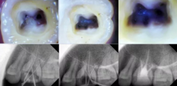 知識分享:根管治療的標(biāo)準(zhǔn)步驟 知識分享:根管治療的標(biāo)準(zhǔn)步驟