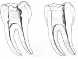 知識分享:根管治療的標(biāo)準(zhǔn)步驟 知識分享:根管治療的標(biāo)準(zhǔn)步驟