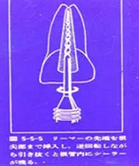 知識分享:根管治療的標(biāo)準(zhǔn)步驟 知識分享:根管治療的標(biāo)準(zhǔn)步驟