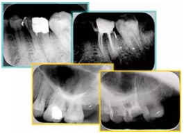 知識分享:根管治療的標(biāo)準(zhǔn)步驟 知識分享:根管治療的標(biāo)準(zhǔn)步驟