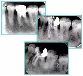 知識分享:根管治療的標(biāo)準(zhǔn)步驟 知識分享:根管治療的標(biāo)準(zhǔn)步驟