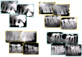 知識分享:根管治療的標(biāo)準(zhǔn)步驟 知識分享:根管治療的標(biāo)準(zhǔn)步驟