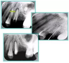 知識分享:根管治療的標(biāo)準(zhǔn)步驟 知識分享:根管治療的標(biāo)準(zhǔn)步驟