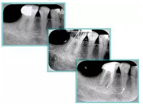 知識分享:根管治療的標(biāo)準(zhǔn)步驟 知識分享:根管治療的標(biāo)準(zhǔn)步驟