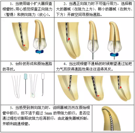 知識分享:根管治療的標(biāo)準(zhǔn)步驟 知識分享:根管治療的標(biāo)準(zhǔn)步驟