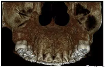 正畸文獻(xiàn)賞析--正畸對(duì)牙槽骨的影響 正畸文獻(xiàn)賞析--正畸對(duì)牙槽骨的影響