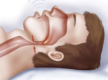 正畸文獻(xiàn)賞析--睡眠與正畸 正畸文獻(xiàn)賞析--睡眠與正畸