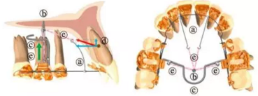 正畸文獻賞析--舌側矯治器的臨床應用 正畸文獻賞析--舌側矯治器的臨床應用