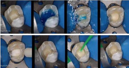 詳細(xì)了解自酸蝕、全酸蝕