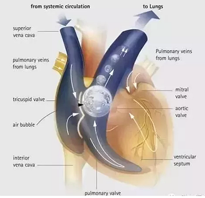 牙醫(yī)要注意！3％雙氧水口腔內(nèi)沖洗致氣體栓塞