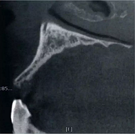 CBCT在種植中應(yīng)用——上頜篇 CBCT在種植中應(yīng)用——上頜篇