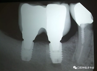 Dennis Tarnow教授|十個(gè)口腔種植熱點(diǎn)問(wèn)題答疑 Dennis Tarnow教授|十個(gè)口腔種植熱點(diǎn)問(wèn)題答疑