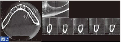 柵欄技術(shù)用于局部三維骨增量 —技術(shù)概述與病例匯報(bào) (1) 柵欄技術(shù)用于局部三維骨增量 —技術(shù)概述與病例匯報(bào) (1)