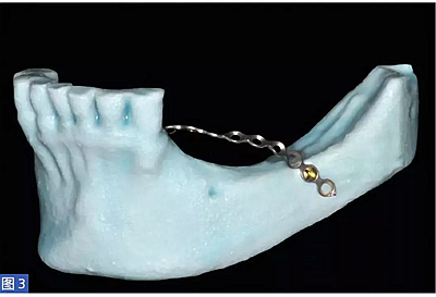 柵欄技術(shù)用于局部三維骨增量 —技術(shù)概述與病例匯報(bào) (1) 柵欄技術(shù)用于局部三維骨增量 —技術(shù)概述與病例匯報(bào) (1)