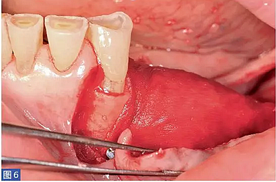 柵欄技術(shù)用于局部三維骨增量 —技術(shù)概述與病例匯報(bào) (1) 柵欄技術(shù)用于局部三維骨增量 —技術(shù)概述與病例匯報(bào) (1)