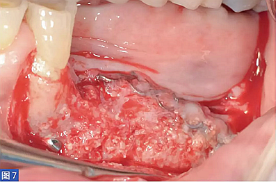 柵欄技術(shù)用于局部三維骨增量 —技術(shù)概述與病例匯報(bào) (1) 柵欄技術(shù)用于局部三維骨增量 —技術(shù)概述與病例匯報(bào) (1)