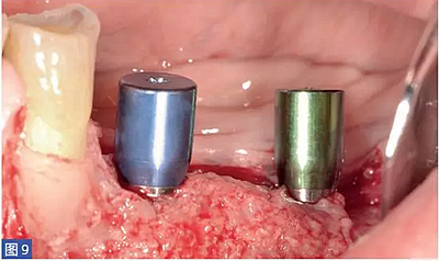 柵欄技術(shù)用于局部三維骨增量 —技術(shù)概述與病例匯報(bào) (1) 柵欄技術(shù)用于局部三維骨增量 —技術(shù)概述與病例匯報(bào) (1)