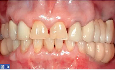 柵欄技術(shù)用于局部三維骨增量 —技術(shù)概述與病例匯報(bào) (1) 柵欄技術(shù)用于局部三維骨增量 —技術(shù)概述與病例匯報(bào) (1)