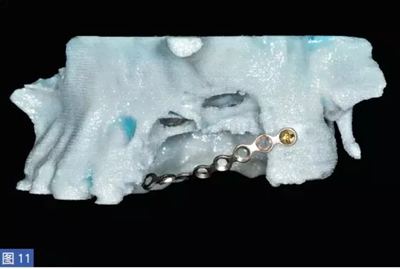 柵欄技術(shù)用于局部三維骨增量 —技術(shù)概述與病例匯報(bào) (1) 柵欄技術(shù)用于局部三維骨增量 —技術(shù)概述與病例匯報(bào) (1)