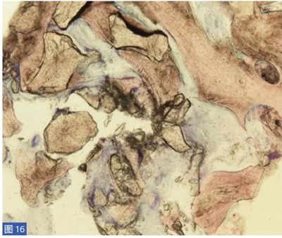 柵欄技術(shù)用于局部三維骨增量 —技術(shù)概述與病例匯報(bào) (2) 柵欄技術(shù)用于局部三維骨增量 —技術(shù)概述與病例匯報(bào) (2)