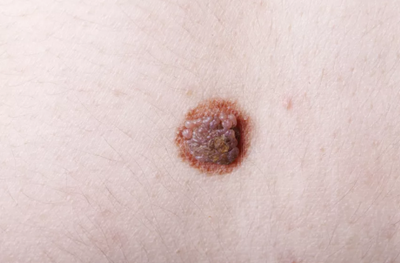 嘴巴里黑黑的好像長(zhǎng)了「痣」？你要當(dāng)心了