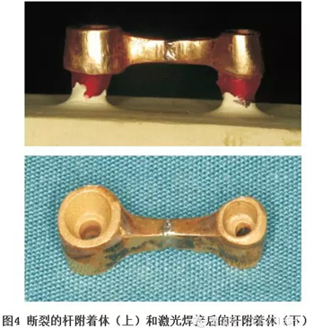 【經驗分享】無牙頜種植修復固位的并發(fā)癥與處理——宋應亮教授 【經驗分享】無牙頜種植修復固位的并發(fā)癥與處理——宋應亮教授