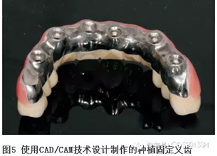 【經驗分享】無牙頜種植修復固位的并發(fā)癥與處理——宋應亮教授 【經驗分享】無牙頜種植修復固位的并發(fā)癥與處理——宋應亮教授