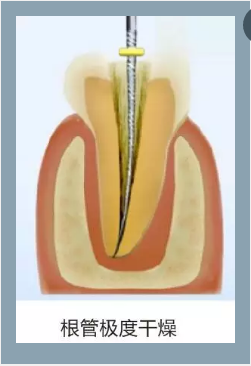 多頻技術(shù)的根管長度測定儀 多頻技術(shù)的根管長度測定儀