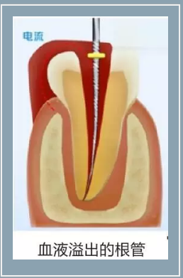 多頻技術(shù)的根管長度測定儀 多頻技術(shù)的根管長度測定儀