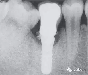 種植失敗的原因 種植失敗的原因