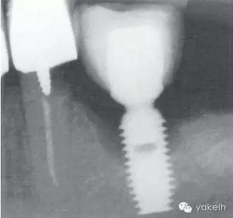 種植失敗的原因 種植失敗的原因