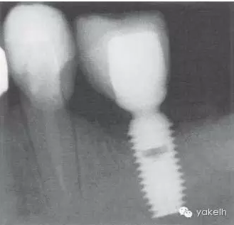 種植失敗的原因 種植失敗的原因