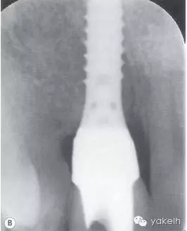 種植失敗的原因 種植失敗的原因