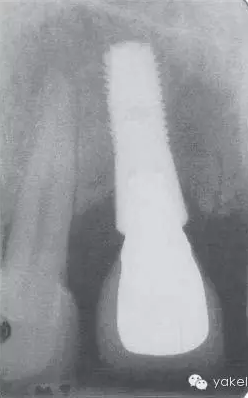 種植失敗的原因 種植失敗的原因