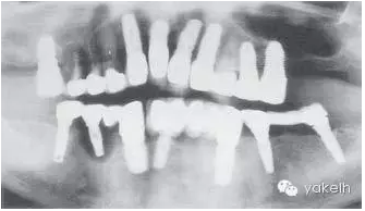 種植失敗的原因 種植失敗的原因