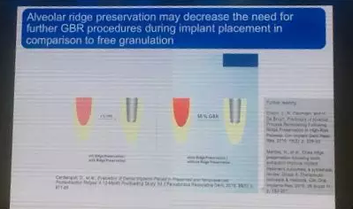 【聽課筆記】拔牙后位點的軟硬組織處理 【聽課筆記】拔牙后位點的軟硬組織處理