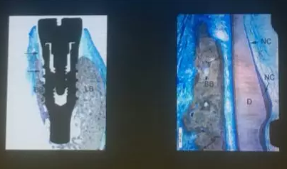 【聽課筆記】拔牙后位點的軟硬組織處理 【聽課筆記】拔牙后位點的軟硬組織處理