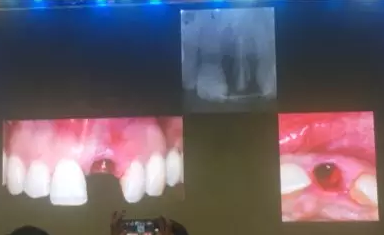 【聽課筆記】拔牙后位點的軟硬組織處理 【聽課筆記】拔牙后位點的軟硬組織處理