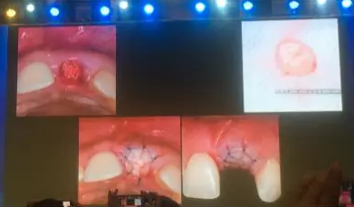 【聽課筆記】拔牙后位點的軟硬組織處理 【聽課筆記】拔牙后位點的軟硬組織處理