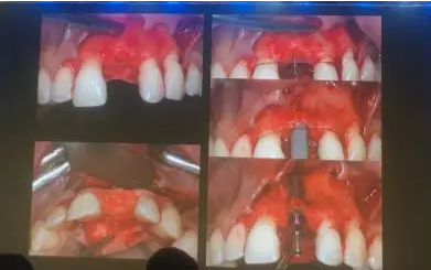 【聽課筆記】拔牙后位點的軟硬組織處理 【聽課筆記】拔牙后位點的軟硬組織處理