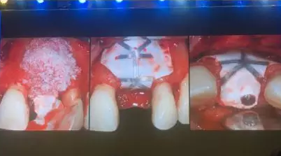 【聽課筆記】拔牙后位點的軟硬組織處理 【聽課筆記】拔牙后位點的軟硬組織處理