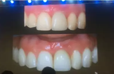 【聽課筆記】拔牙后位點的軟硬組織處理 【聽課筆記】拔牙后位點的軟硬組織處理