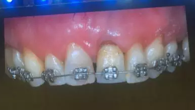 【聽課筆記】拔牙后位點的軟硬組織處理 【聽課筆記】拔牙后位點的軟硬組織處理